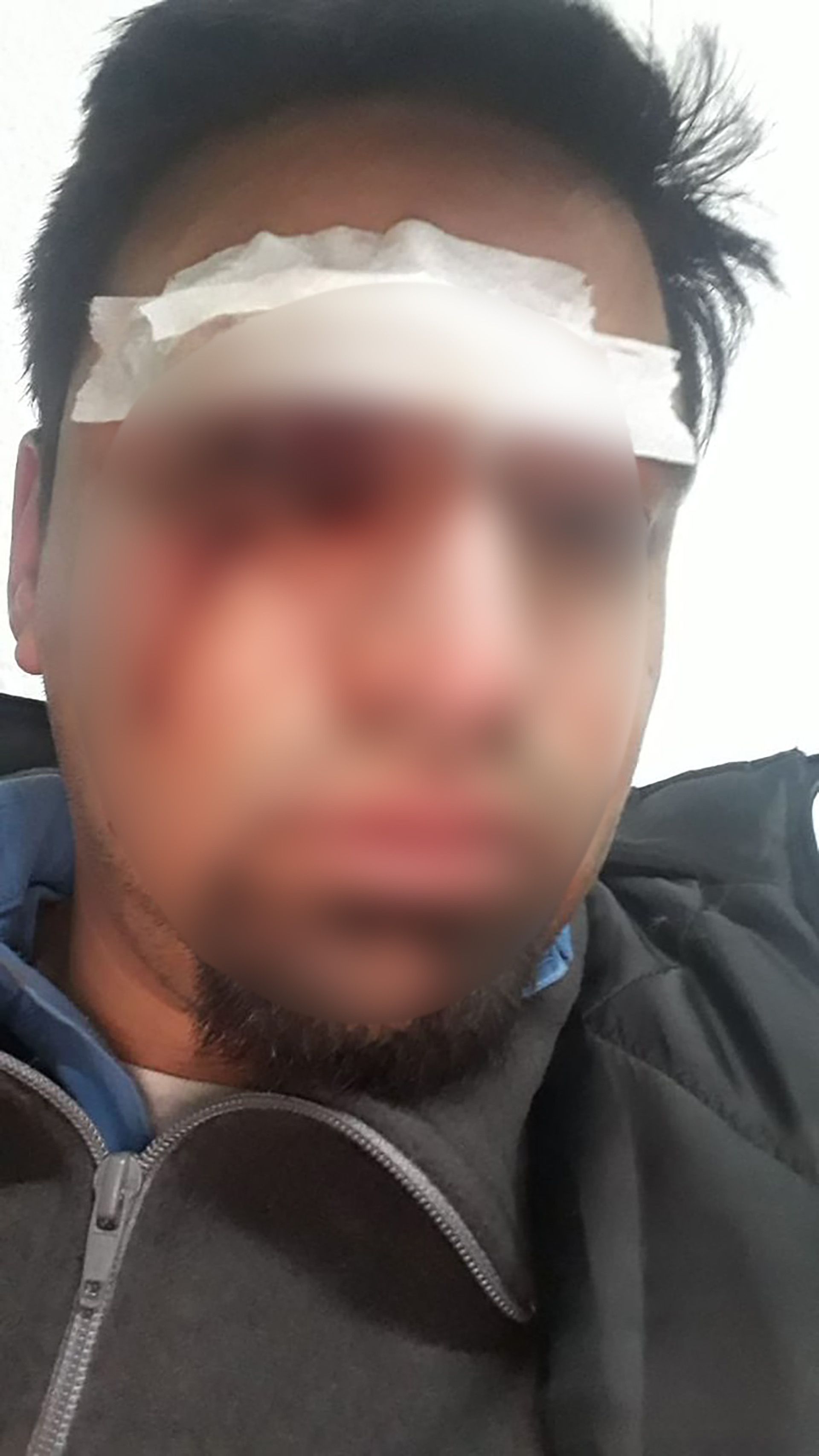 El conductor, que también usaba anteojos, sufrió graves cortes en el ojo y tiene comprometida la retina