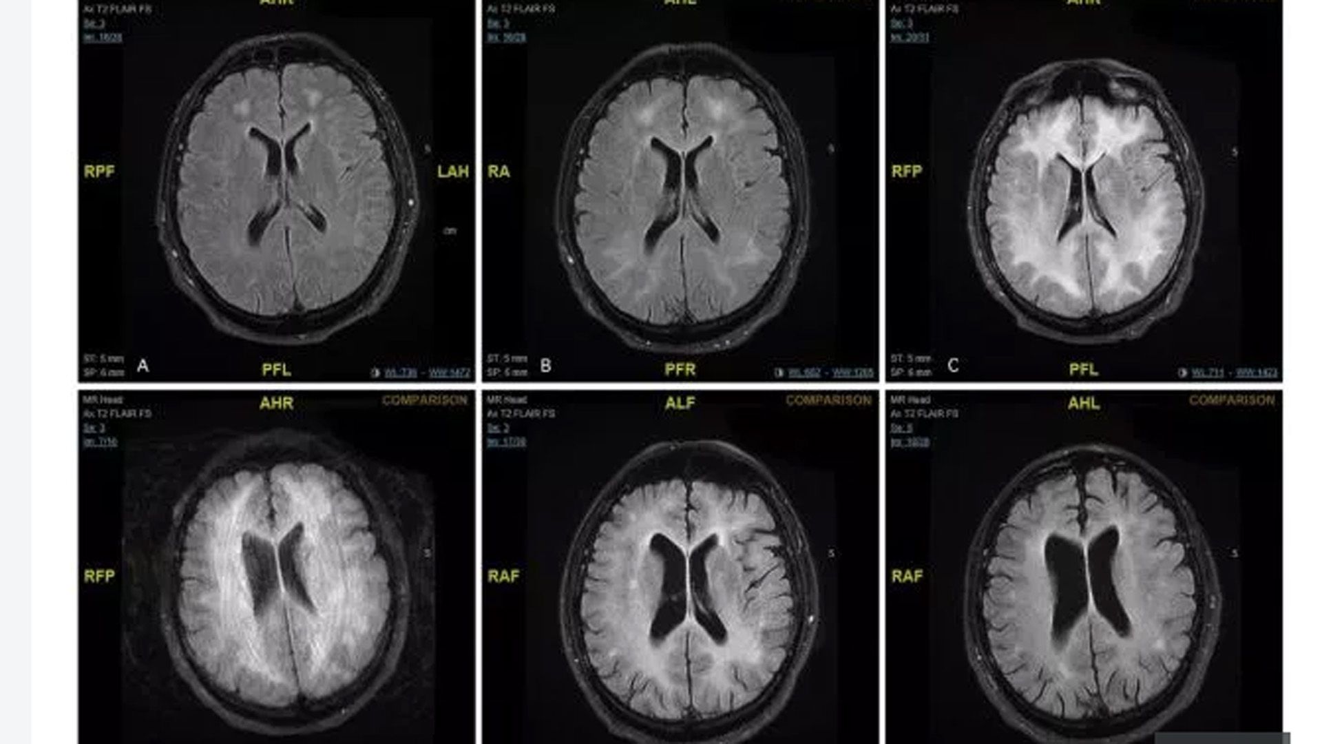 Las imágenes del cerebro muestran una disminución en los receptores de dopamina (D2) en el cerebro de una persona adicta a la cocaína en comparación con una persona que no consume drogas (Gentileza The Sun)
