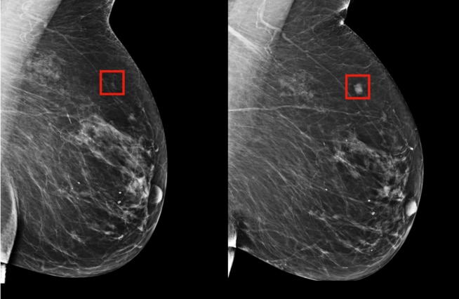 Mediante mamografías se pueden diagnosticar tumores que no se ven a simple vista (Foto: MIT)