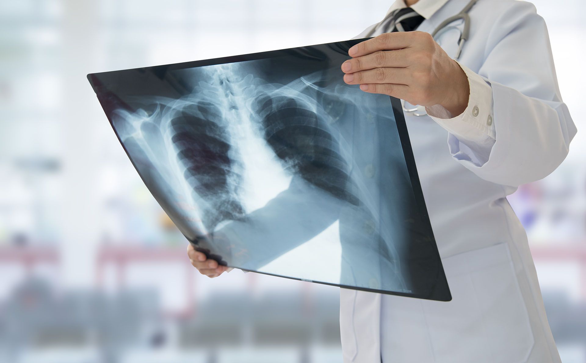 La neumonía es una enfermedad respiratoria caracterizada por una infección en los pulmones (Shutterstock)
