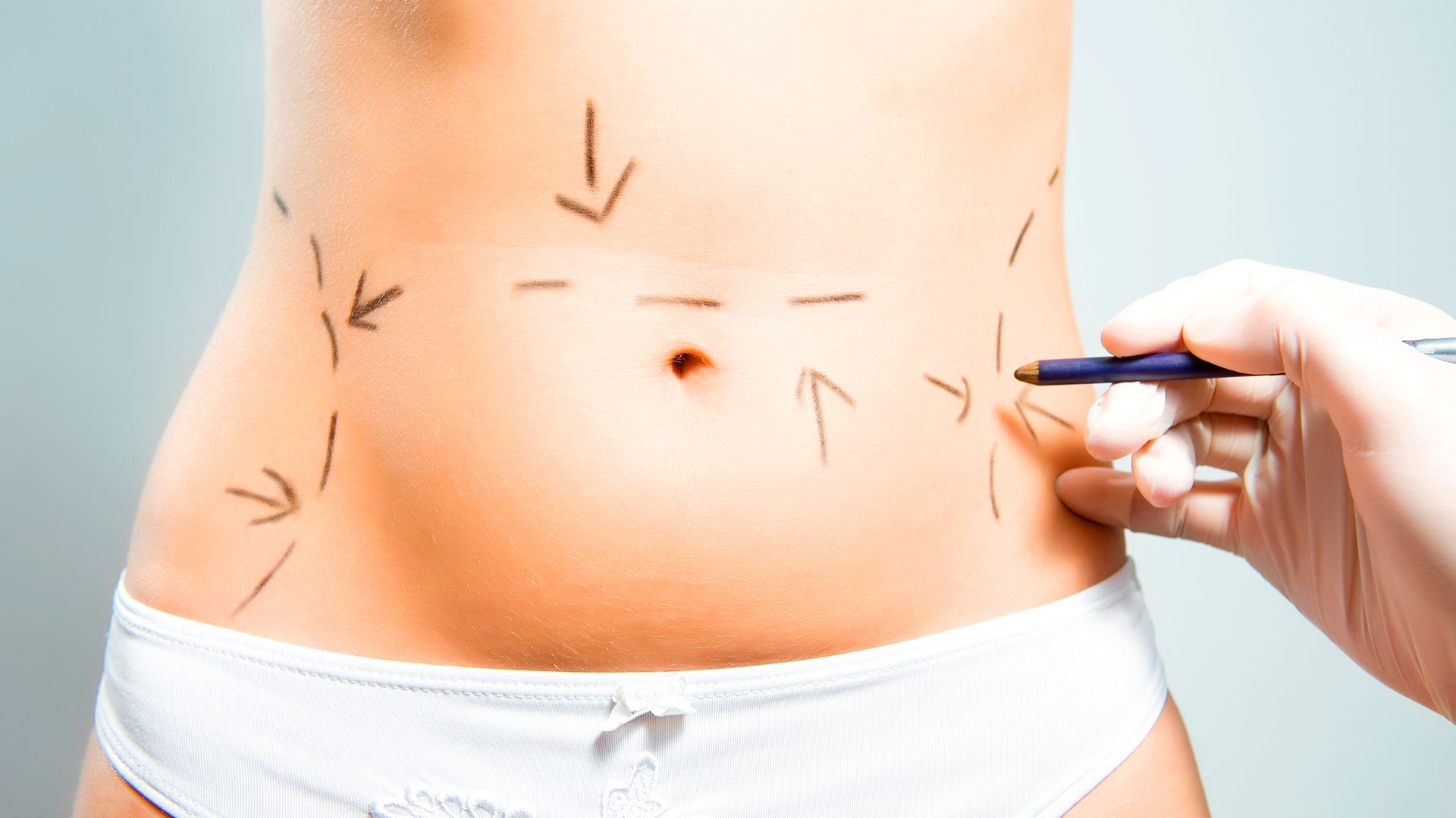 La abdominoplastía es el procedimiento ideal para reducir drásticamente el aspecto "abombado" del abdomen (Shutterstock)