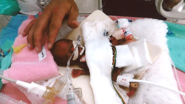 El "bebé más chiquito del mundo", a punto de dejar el hospital