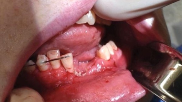 El peligro de los cigarrillos electrónicos: mandíbula fracturada y dientes rotos