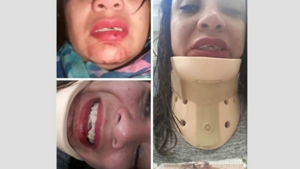 Iba a su despedida de soltera y fue atacada por motochorros: "Me pegaron trompadas en la cara"