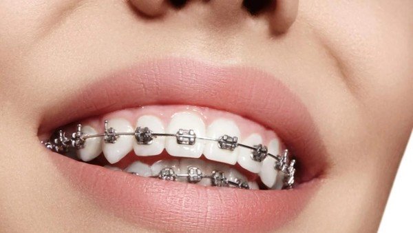 La ANMAT prohibió la comercialización de dos productos médicos indicados en tratamientos de ortodoncia