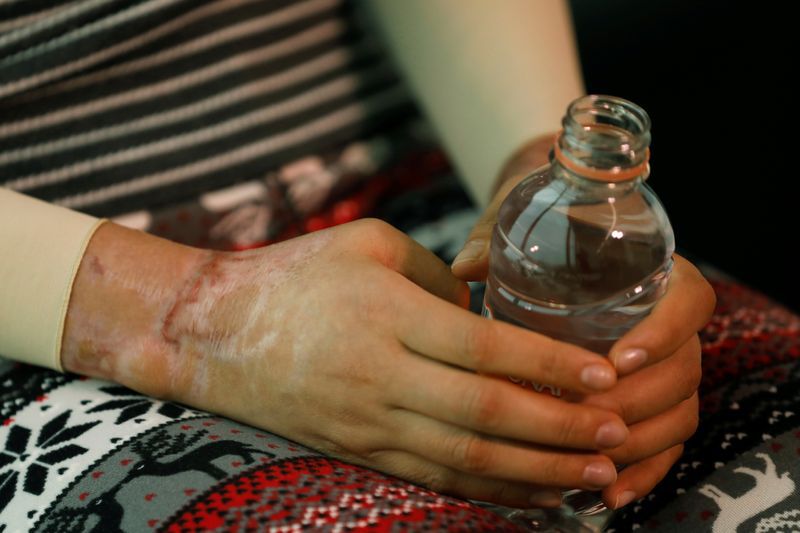 Sufrió quemaduras en su rostro y cuerpo. REUTERS/Carlos Jasso