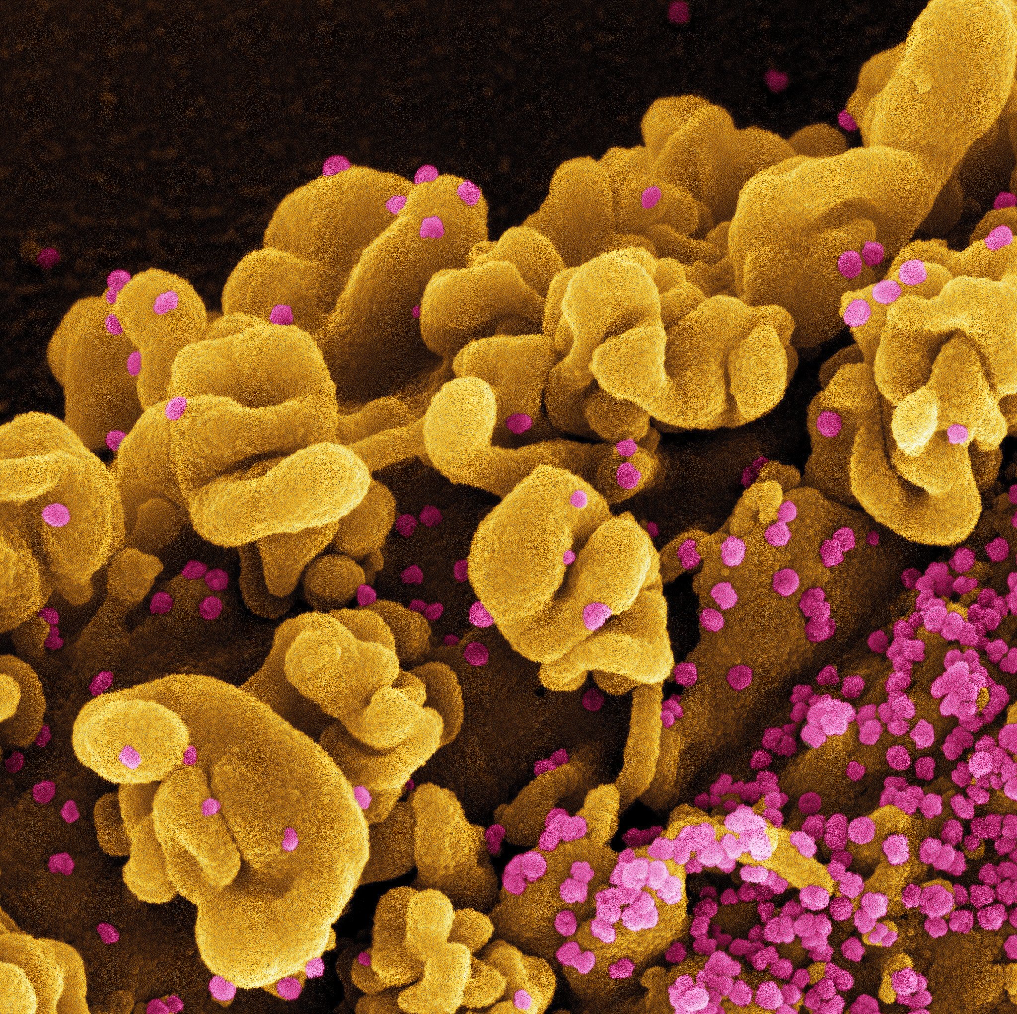 Colorized scanning electron micrograph of a cell infected with the Omicron strain of SARS-CoV-2 virus particles (pink), isolated from a patient sample. Image captured at the NIAID Integrated Research Facility (IRF) in Fort Detrick, Maryland. CREDIT
NIAID